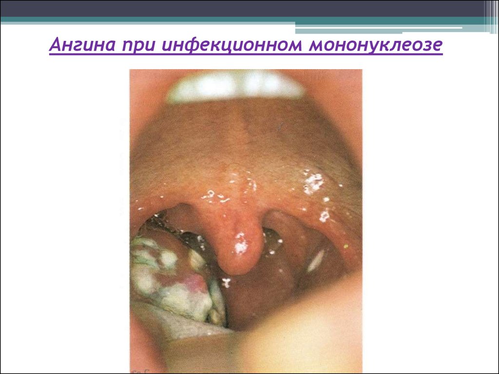 Ангина при инфекционном мононуклеозе