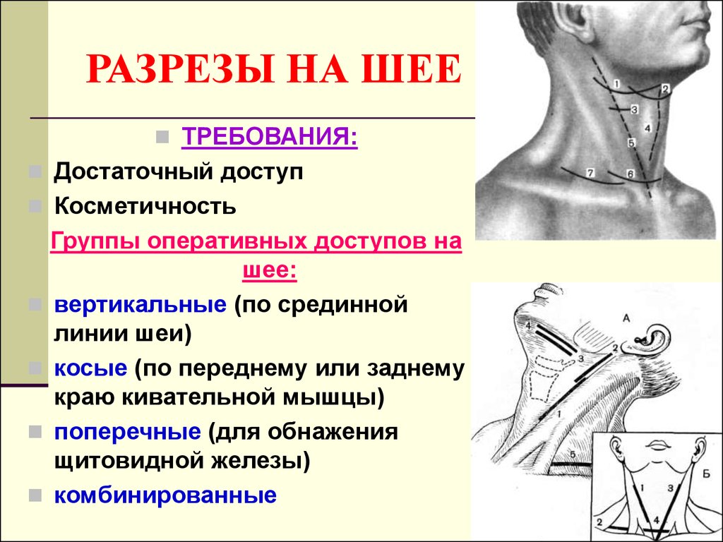 Шейные операции. Операции на шее топографическая анатомия. Разрезы шеи Оперативная хирургия и топографическая анатомия. Классификация оперативных доступов к органам шеи.