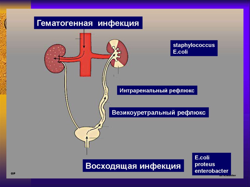 Гематогенный. Восходящая инфекция почек. Гематогенный путь инфицирования почек. Восходящий инфекции почек это. Патофизиология почек.