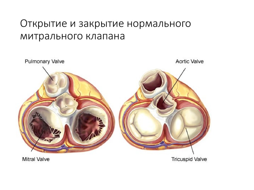 Митральные пороки презентация