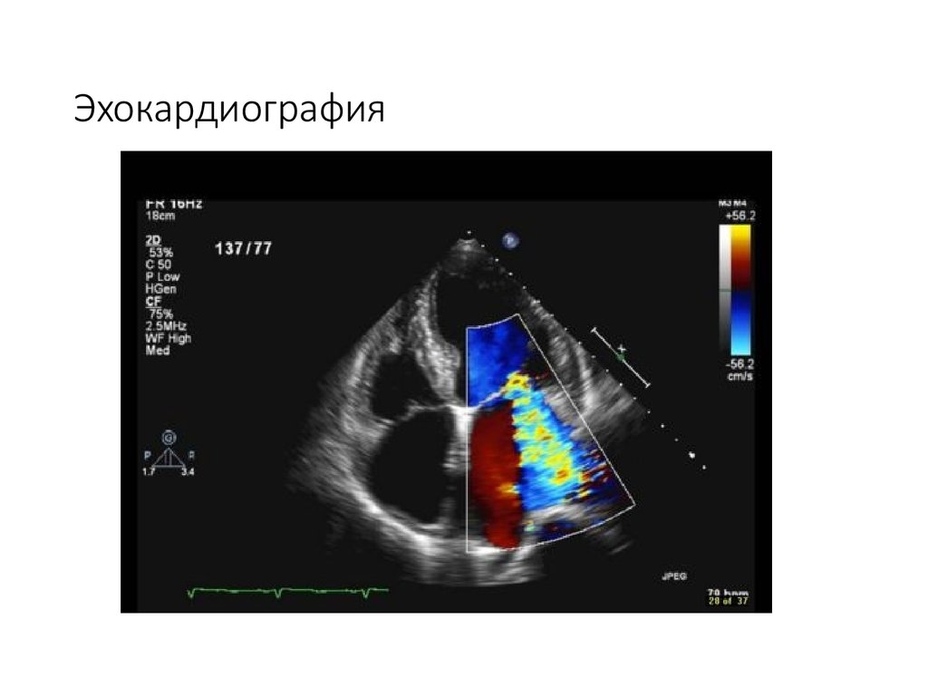 Эхокардиография сердца презентация