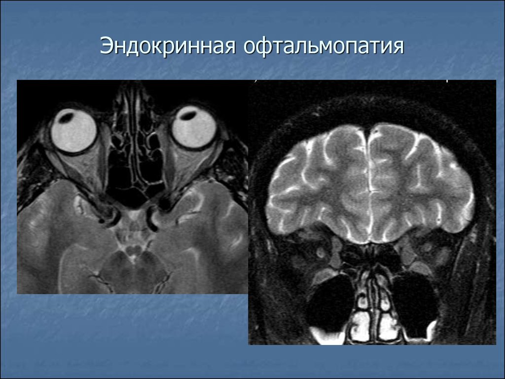 Эндокринная офтальмопатия