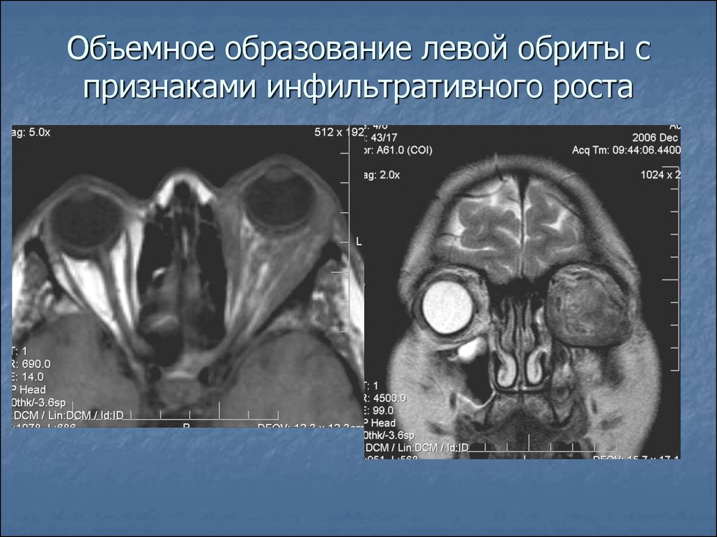 Изменения в левом. Образование с признаками инфильтративного роста. Механизмы инфильтративного роста. Экстракраниальное объемное образование левой орбиты.