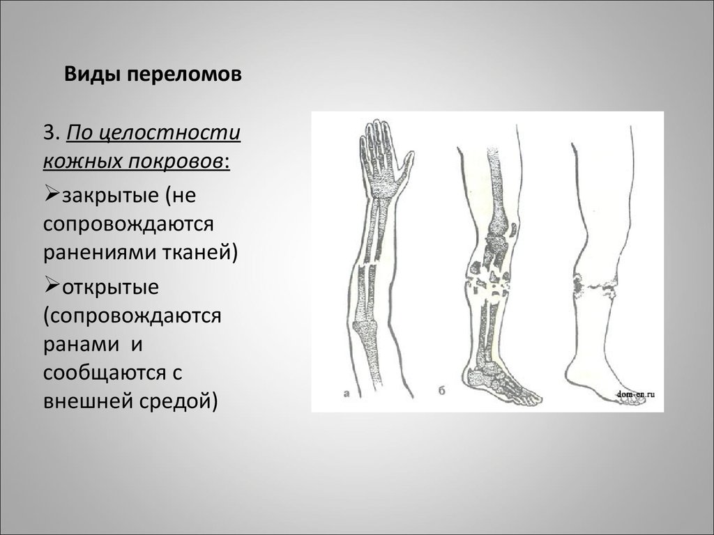 Переломы бывают. Виды переломов по целостности кожного Покрова. Переломы по целостности кожных покровов.