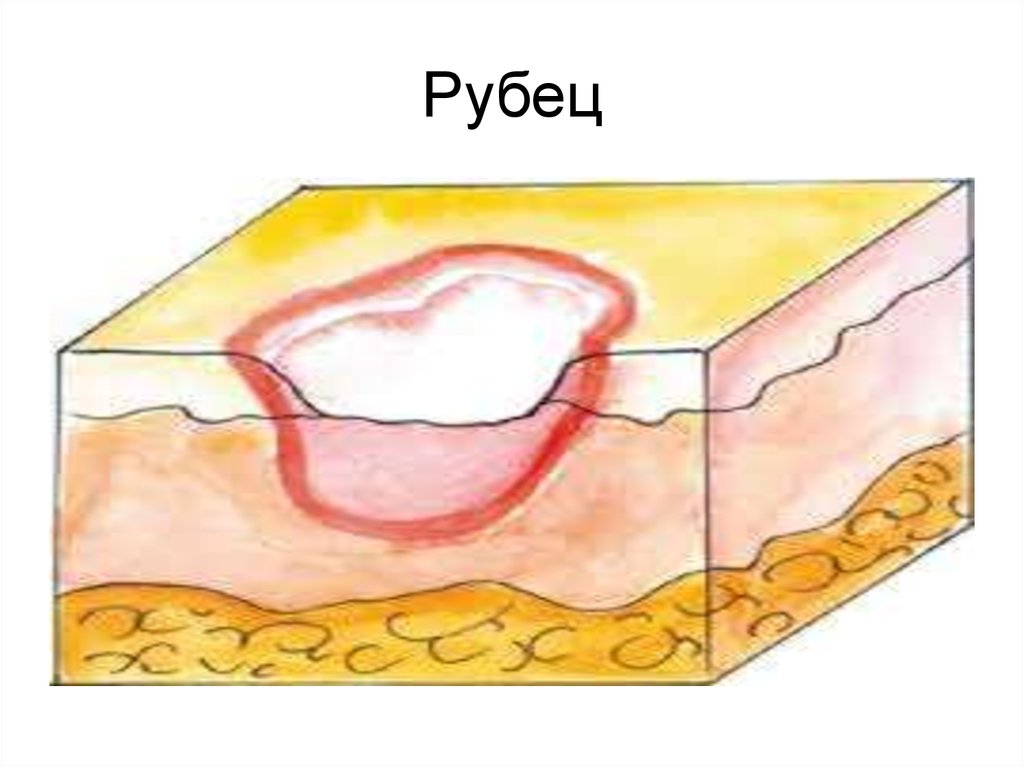 Образование рубцовой ткани