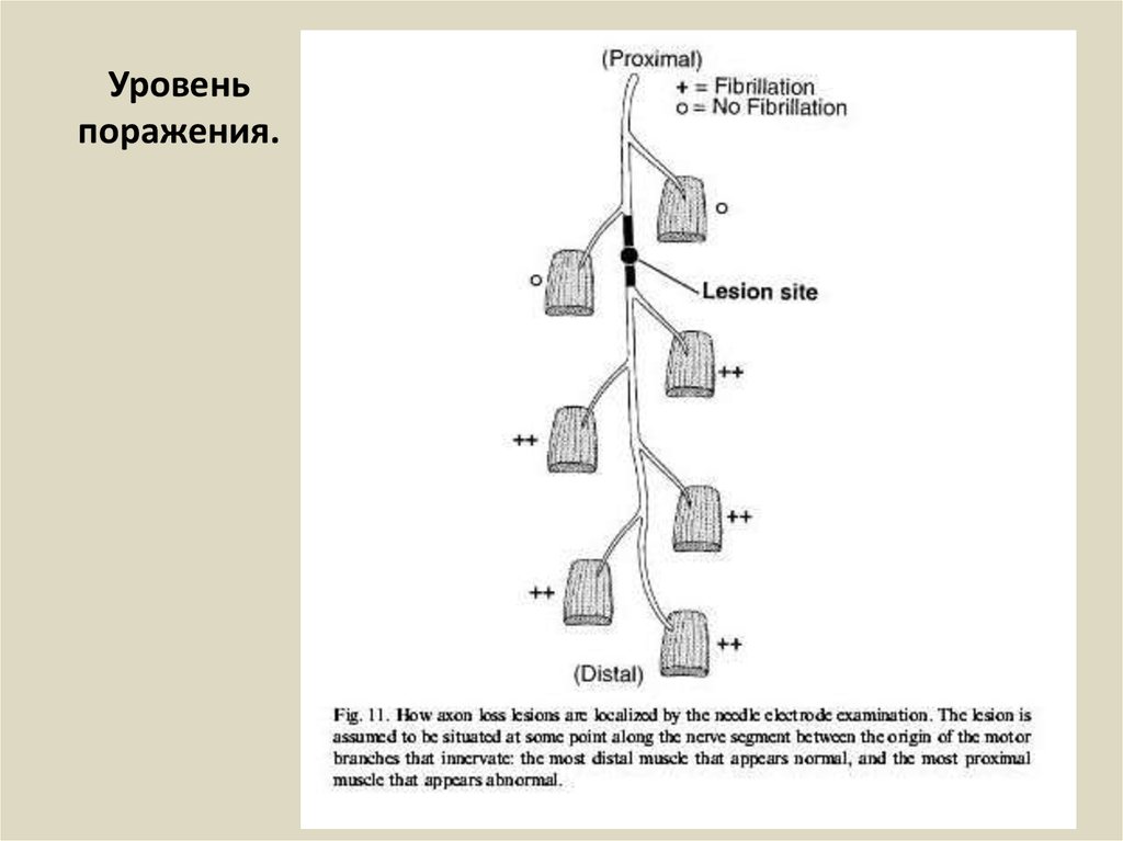 Уровень поражения.