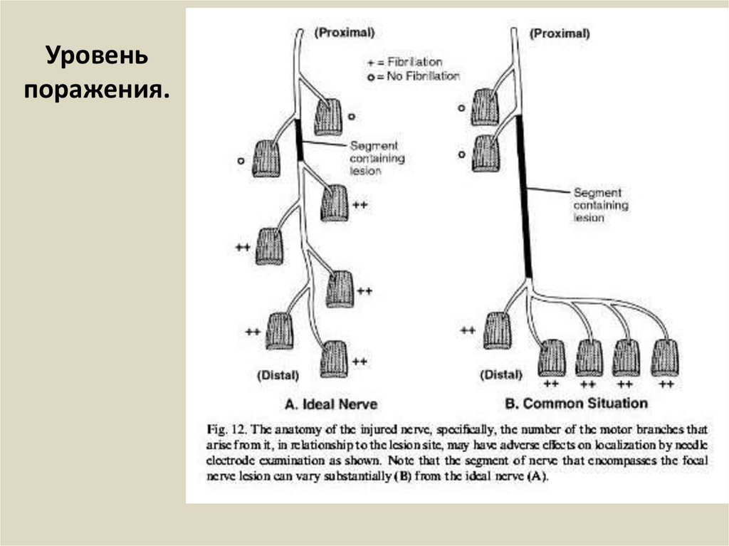 Уровень поражения