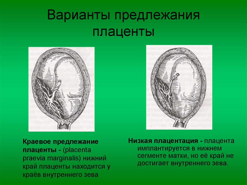 Центральное предлежание плаценты