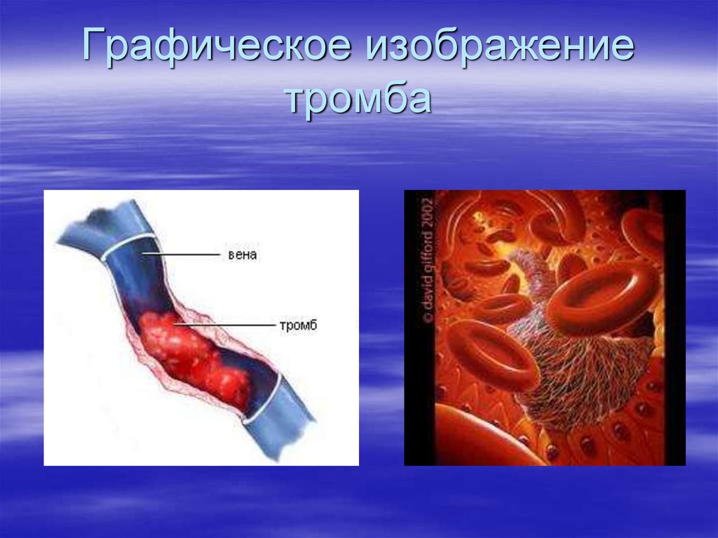 Картинка оторвался тромб