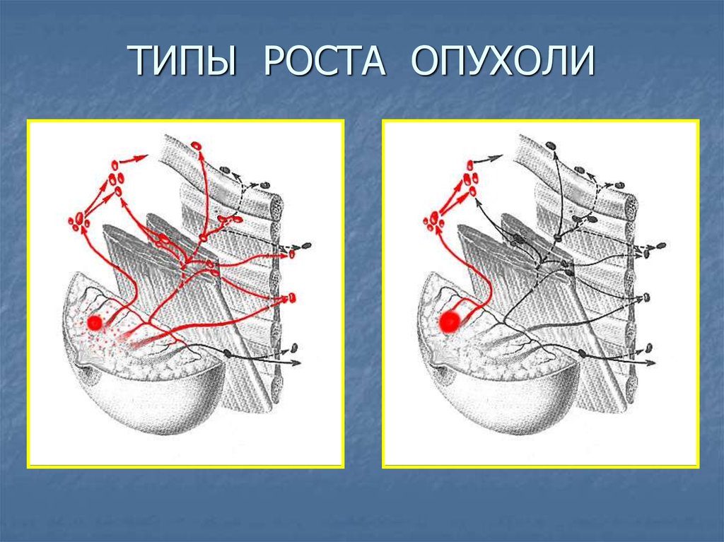 Рост опухоли. Типы роста опухолей. Рост опухоли (типы роста).. Зарисовать виды роста опухолей.