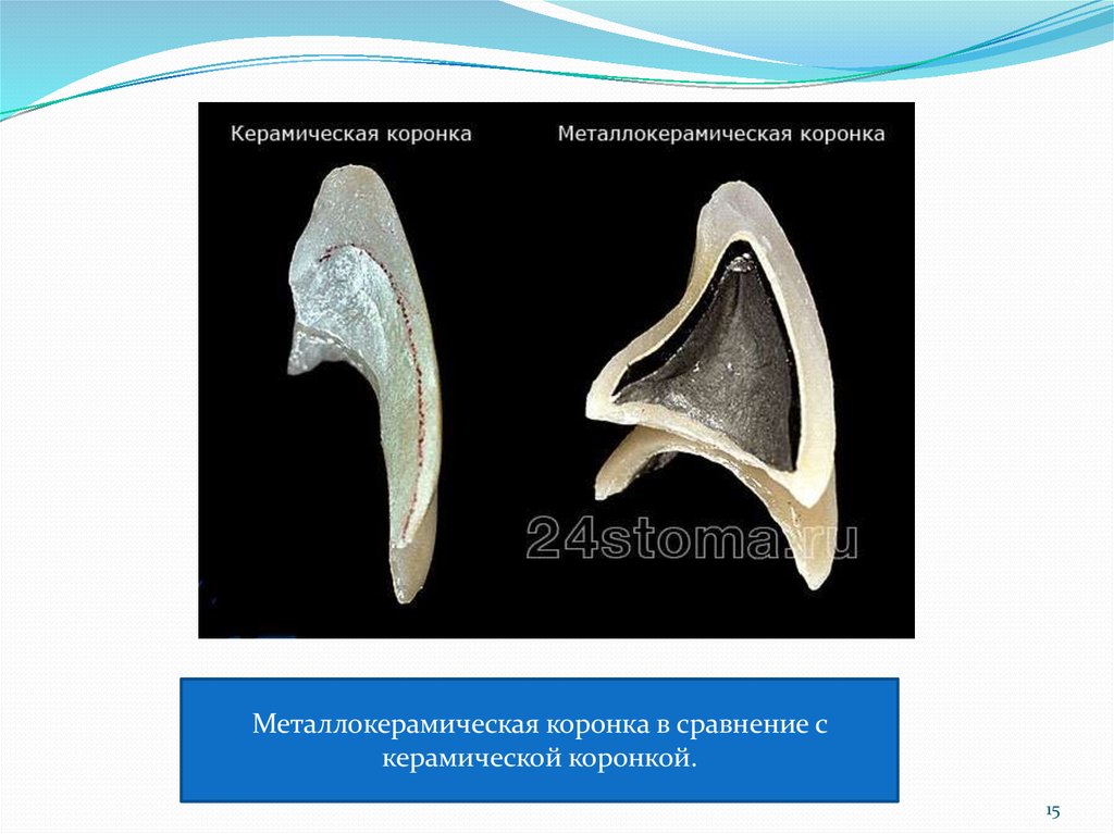 Реферат: Металлокерамические коронки