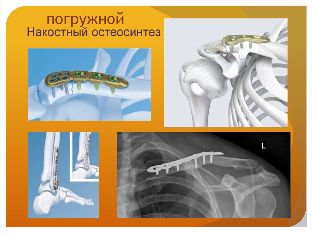 Остеосинтез ключицы пластиной