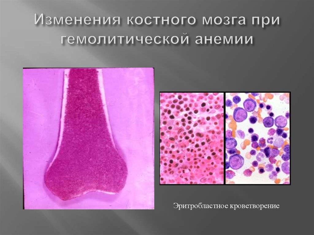 Сигнал от костного мозга неоднородный. Трепанобиопсия костного мозга. Трепанобиопсия костного мозга при повышенных тромбоцитах. Гистология костного мозга при лейкозе. Гиперплазия костного мозга гистология.