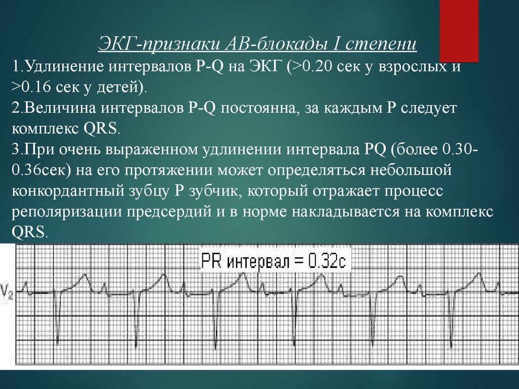 Экг 1. Признаки АВ блокады 1 степени. Признаки АВ блокады 1 степени на ЭКГ. АВ блокада 1 степени на ЭКГ. ЭКГ критерии атриовентрикулярной блокады.