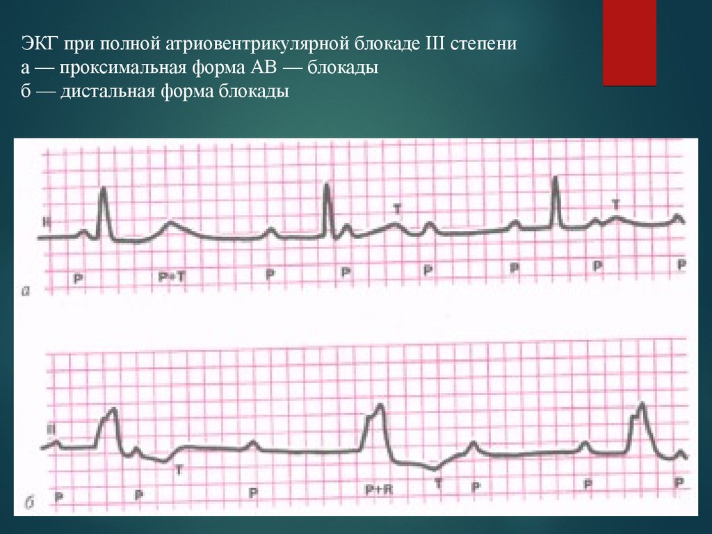 Экг 3. АВ блокада 3 степени проксимальный ЭКГ. АВ блокада 3 степени дистальный Тип. Атриовентрикулярная блокада 3 степени дистальный Тип ЭКГ. Полная АВ блокада 3 степени ЭКГ.