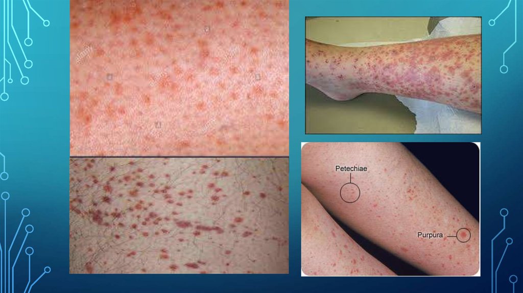 Idiopathic thrombocytopenic purpura - online presentation