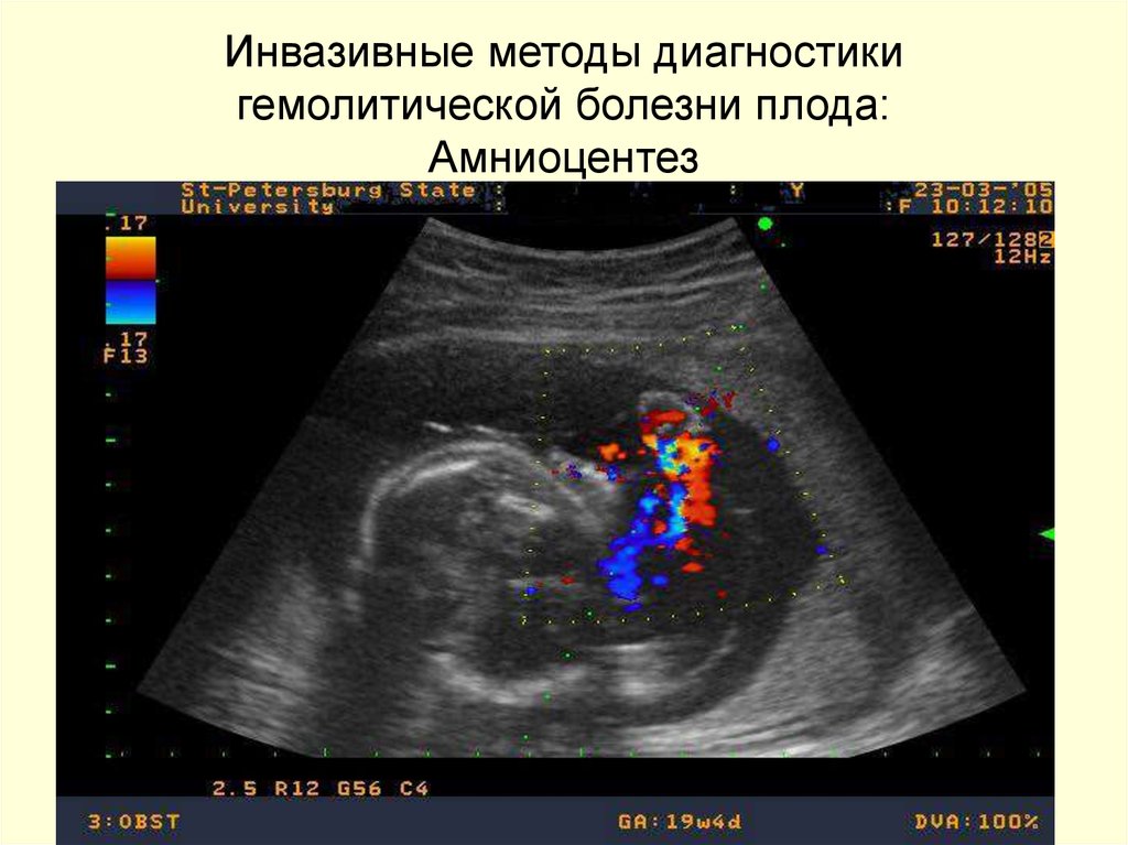 Диагностика плода. Диагностика гемолитической болезни плода. Гемолитическая болезнь новорожденного диагностика. Отечная форма гемолитической болезни плода. Гемолитическая болезнь плода УЗИ.