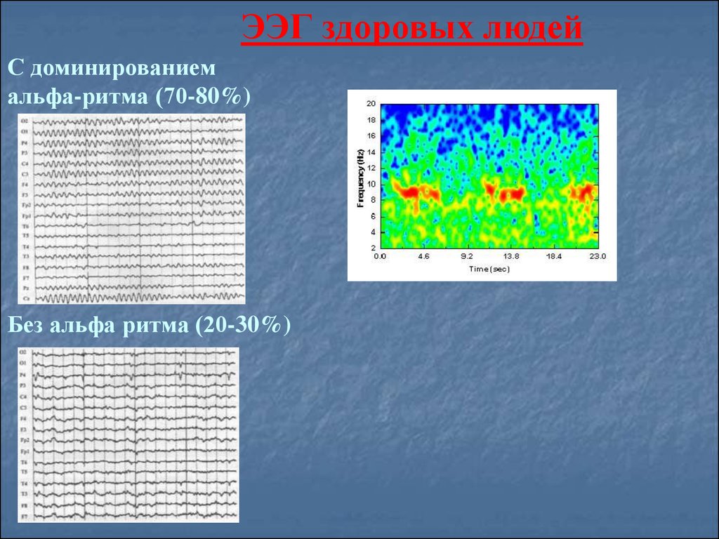 Альфа ритм. ЭЭГ здорового человека. Ритм ЭЭГ У здорового человека. Доминирующий Альфа ритм ЭЭГ. На ЭЭГ Альфа ритм доминирует.