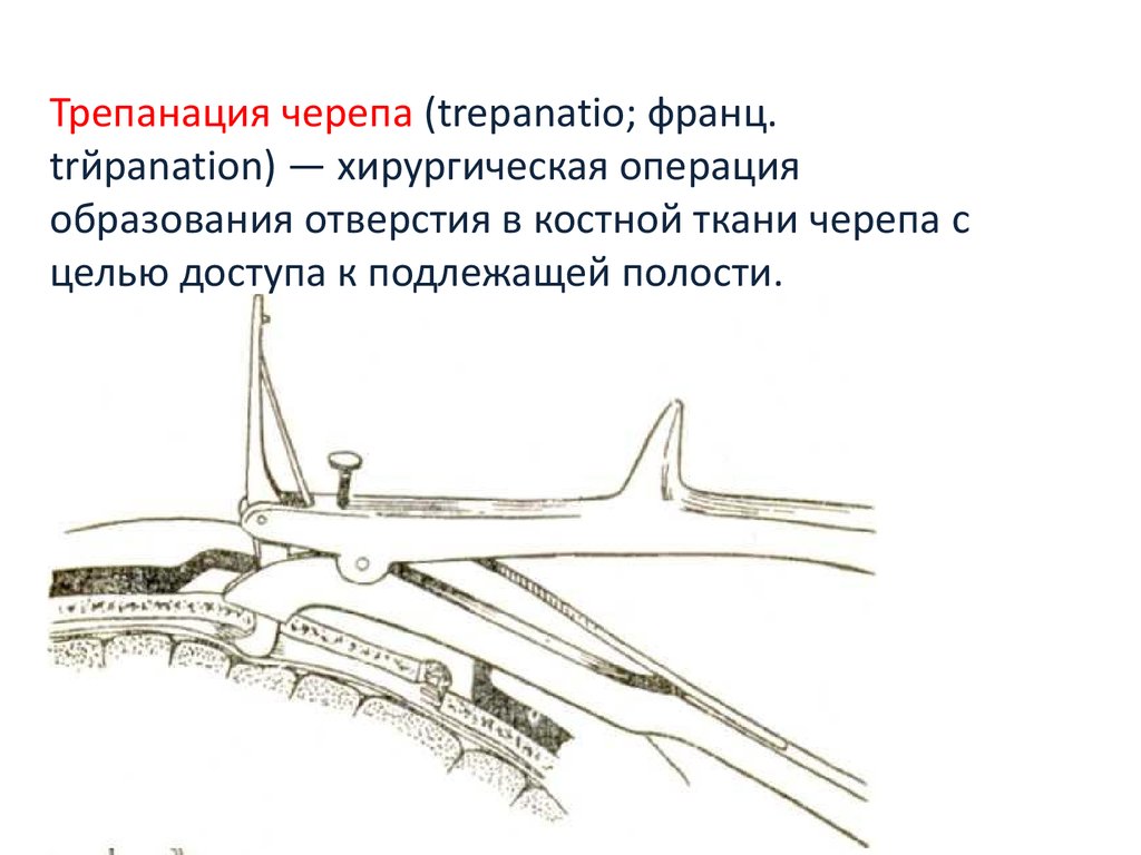 Схема трепанации черепа по способу оливекрона