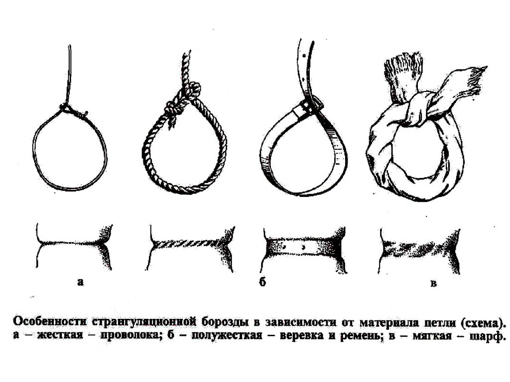 Петля глисона своими руками инструкция чертеж