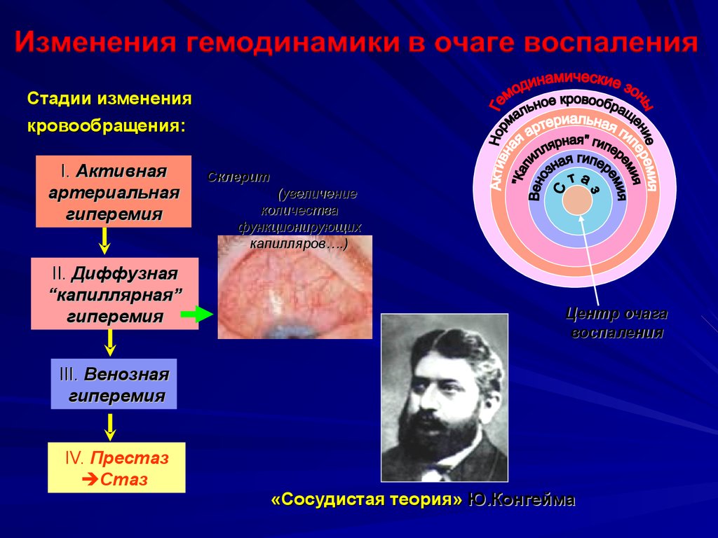 Артериальная гиперемия воспаление. Опыт конгейма воспаление. Стадии сосудистой реакции. Опыт конгейма патофизиология воспаление. Изменение гемодинамики в очаге воспаления.