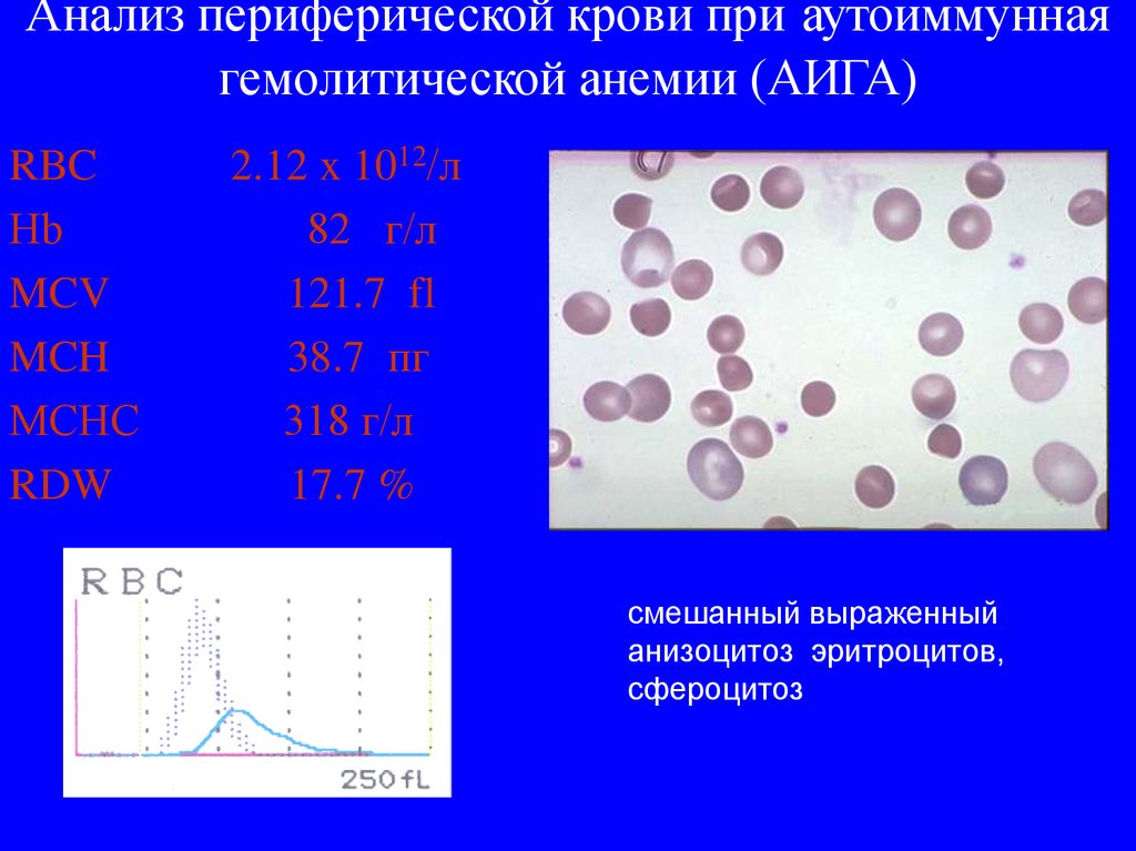 Mch анемия. Гемолитическая анемия анализ крови. Анизоцитоз при гемолитической анемии. Анализы при гемолитической анемии. Гемолитическая анемия анализ крови показатели.
