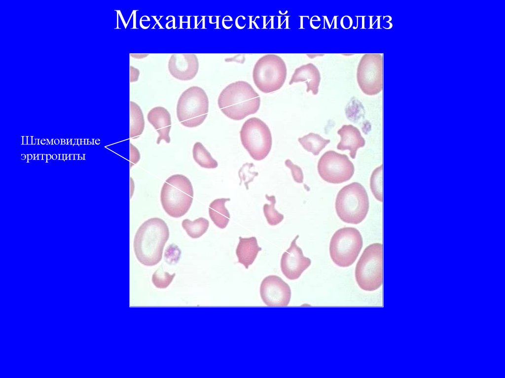 Распад эритроцитов. Механический гемолиз эритроцитов. Гемолиз эритроцитов микроскопия. Гемолиз крови мазок. Гемолиз в мазке крови.
