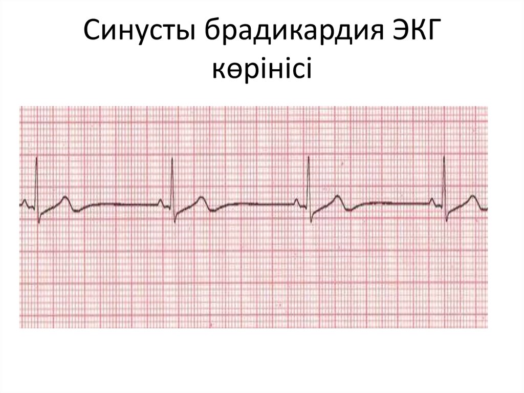 Синусовая брадикардия экг фото