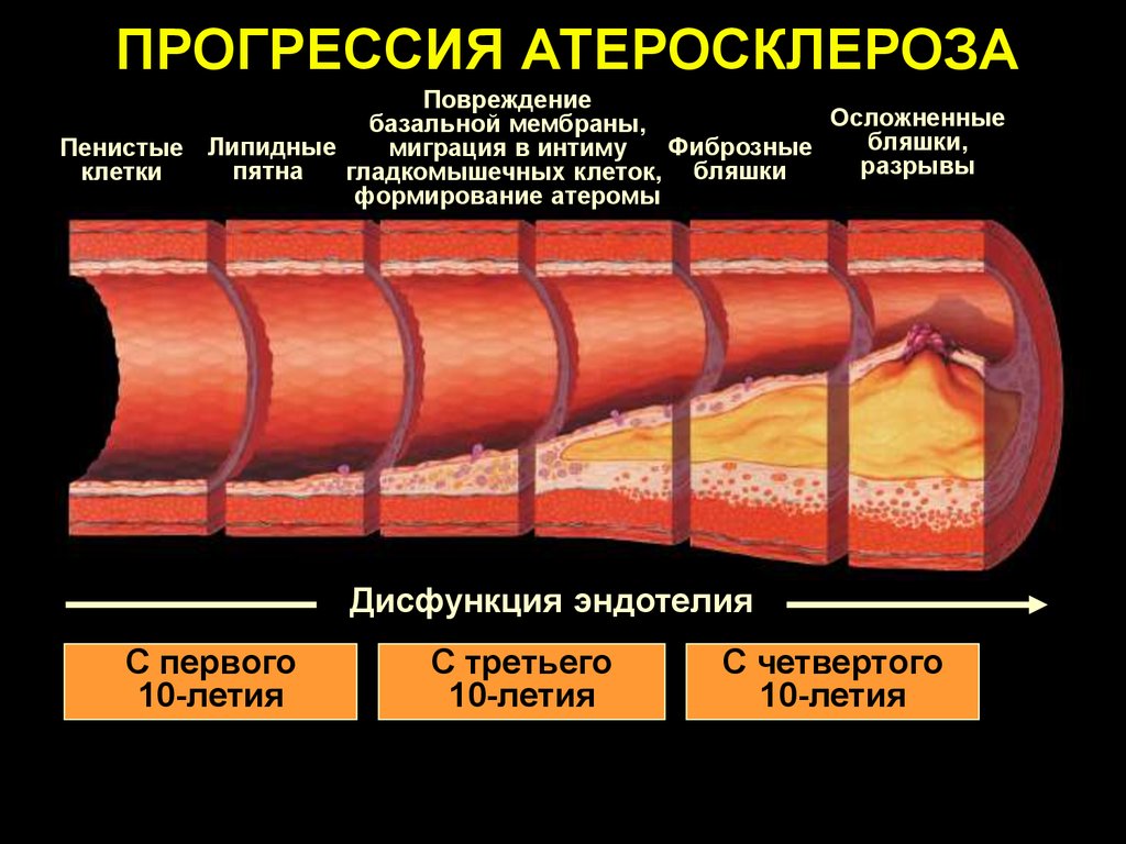 Толстая стенка сосуда. Механизм развития атеросклероза сосудов. Патогенез атеросклероза повреждение эндотелия. Стадии развития атеросклеротической бляшки. Этапы формирования атеросклеротической бляшки.