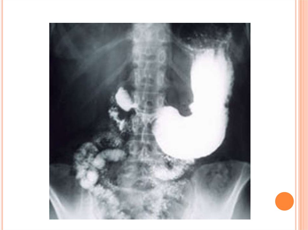 Рентгеноскопия пищевода подготовка. Рентген желудка и 12-перстной кишки. Рентген двенадцатиперстной кишки. Рентгеноскопия желудка и 12 перстной кишки.