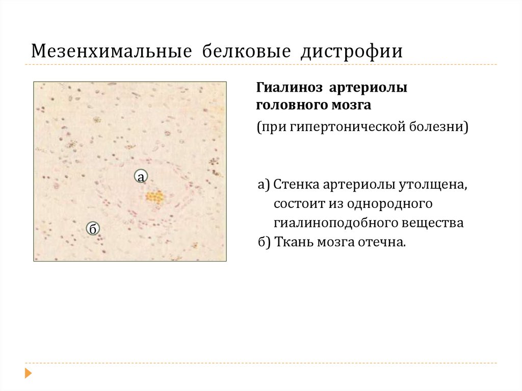 Гиалиноз относится к. Гиалиноз артериол головного мозга микропрепарат. Белковые мезенхимальные дистрофии гиалиноз. Виды мезенхимальной белковой дистрофии. Белковые мезенхимальные дистрофии заболевания.