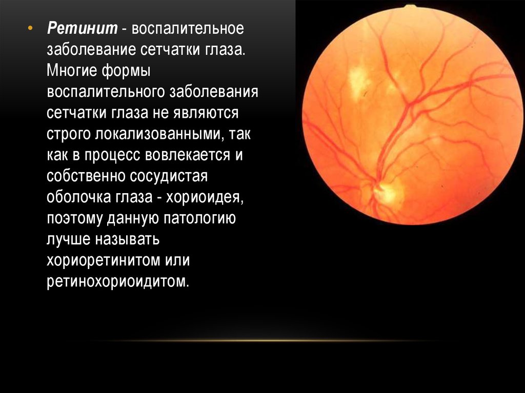 Воспаление сетчатки. Пигментный ретинит сетчатки. Группа воспалительных заболеваний сетчатки глаза.
