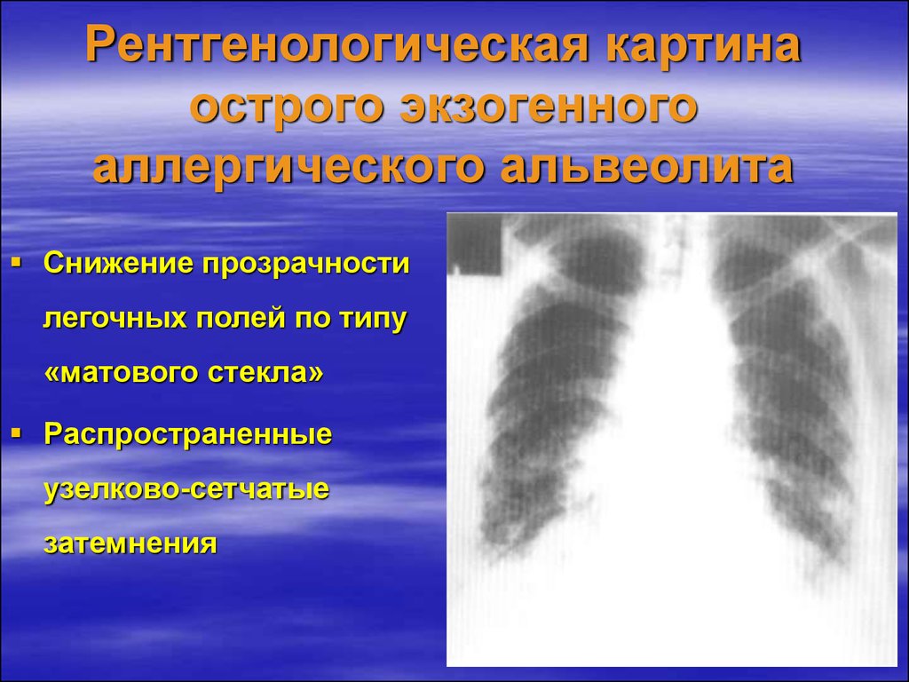 Экзогенный аллергический альвеолит у детей презентация