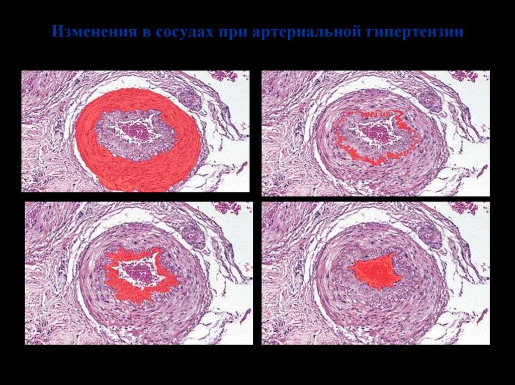 Патанатомия гипертоническая болезнь презентация