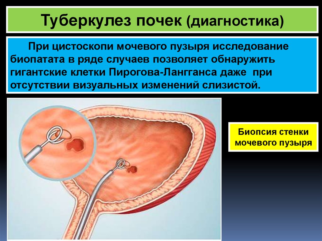 Туберкулез мочевой системы. Туберкулез мочевого пузыря цистоскопия. Туберкулёз мочеполовой системы. Туберкулёз мочевой системы.