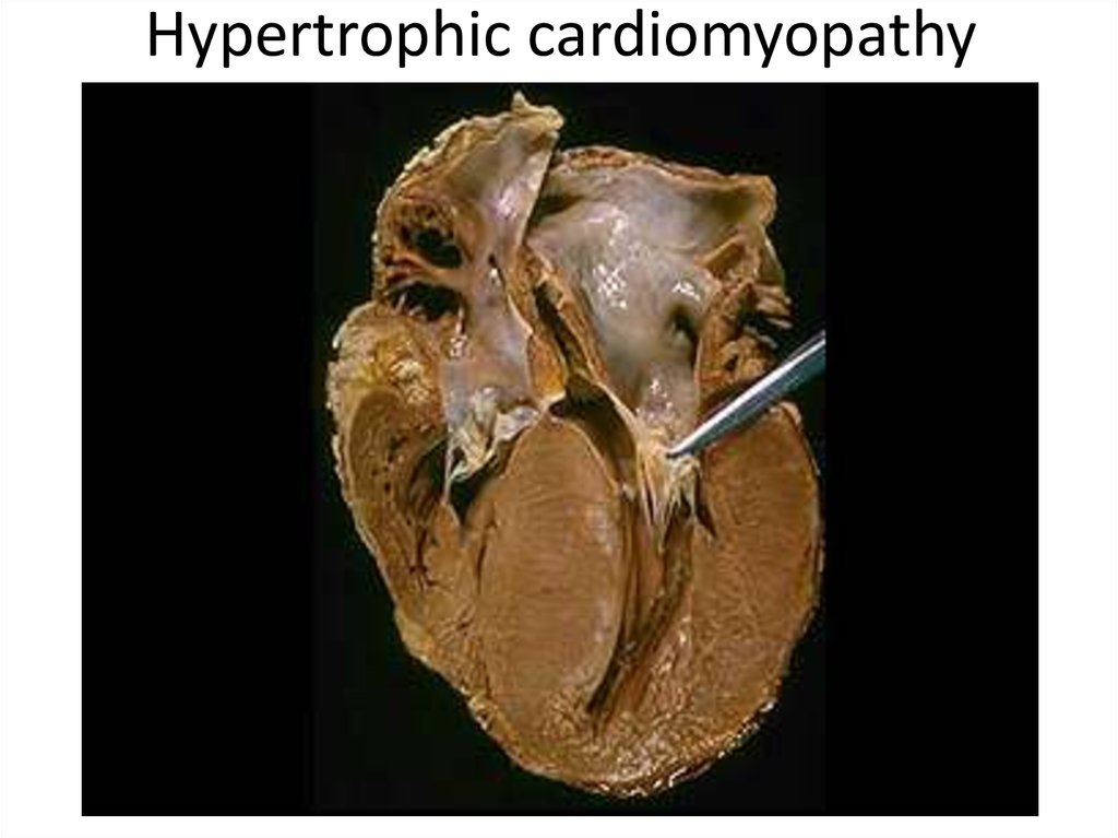 Hypertrophic cardiomyopathy