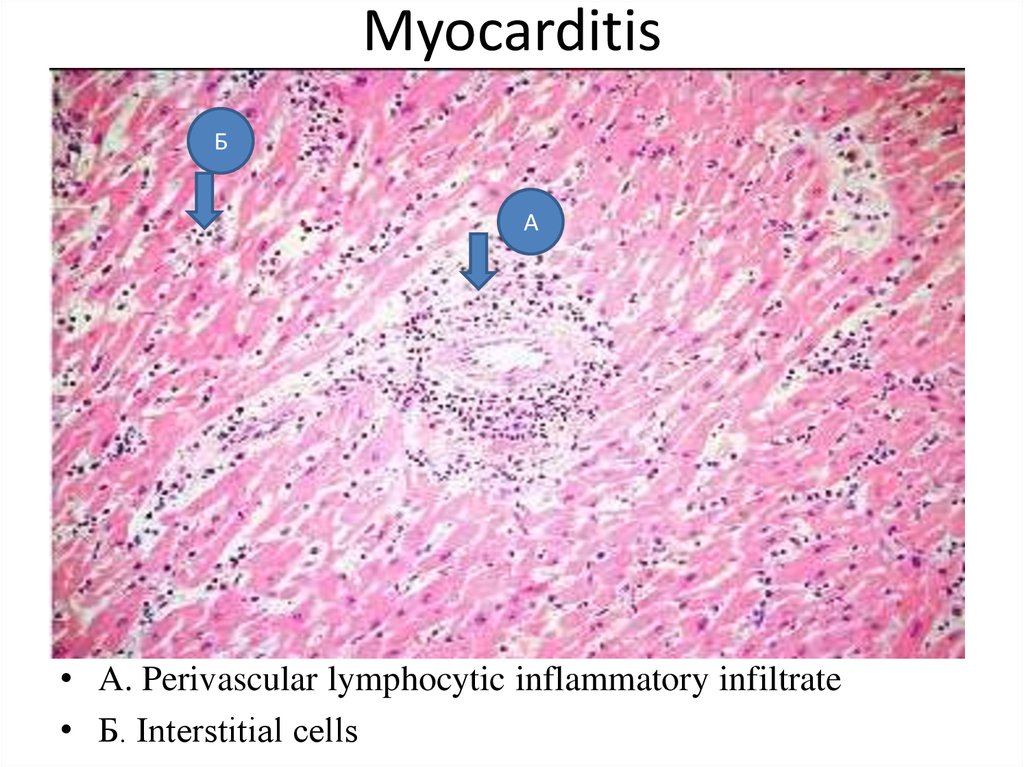 Myocarditis