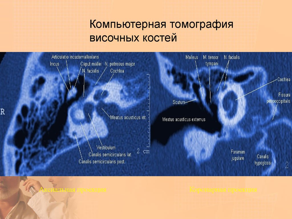 Кт височных. Кт среднего уха и височных костей. Кт височной кости среднего и внутреннего уха. Коронарная проекция кт височных костей. Кт анатомия височных костей.