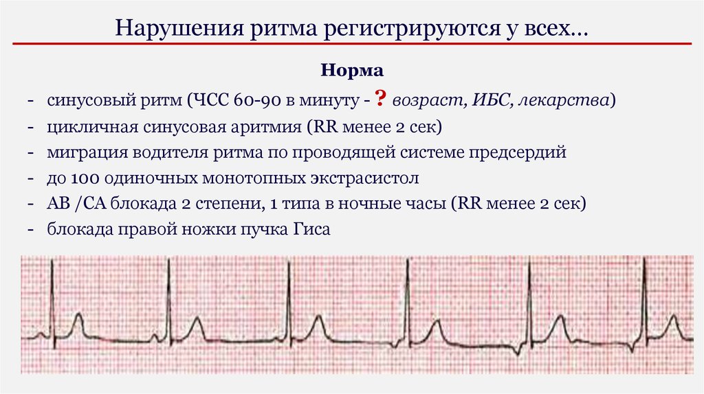 Что значит ритм сердца. Кардиограмма сердца синусовый ритм норма. Норма ЭКГ синусный ритм. Синусовый ритм на ЭКГ норма. Показатель синусовой аритмии в ЭКГ.