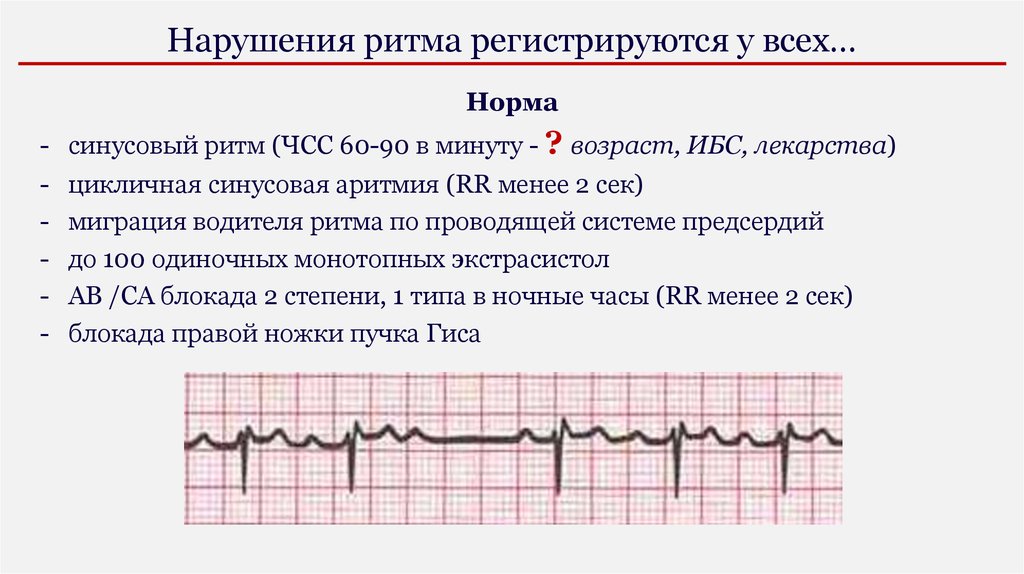 Миграция водителя ритма синусовый узел. Миграция водителя ритма. Ритм сердца норма. Миграция водителя ритма 10 у детей. Тембр сердца в норме.