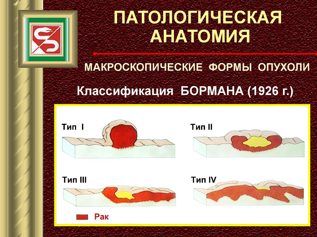 Рак желудка патанатомия презентация