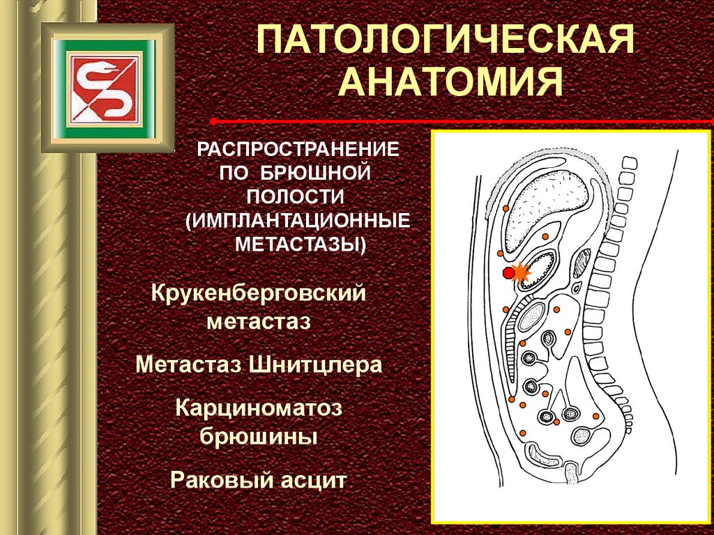 Рак брюшной. Имплантационные метастазы брюшной полости. * Имплантационные метастазы в брюшине. Имплантационное метастазирование это.