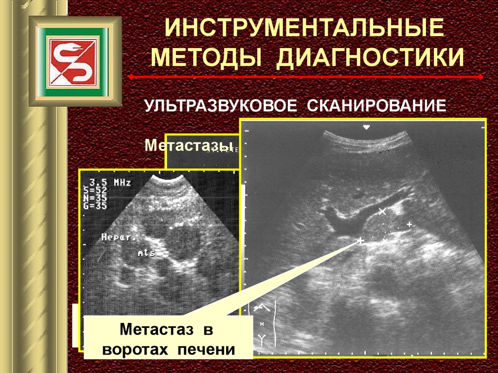 Вылечить метастазы в печени. Метастатические опухоли печени. Метастатическое поражение печени. Новообразование в воротах печени.