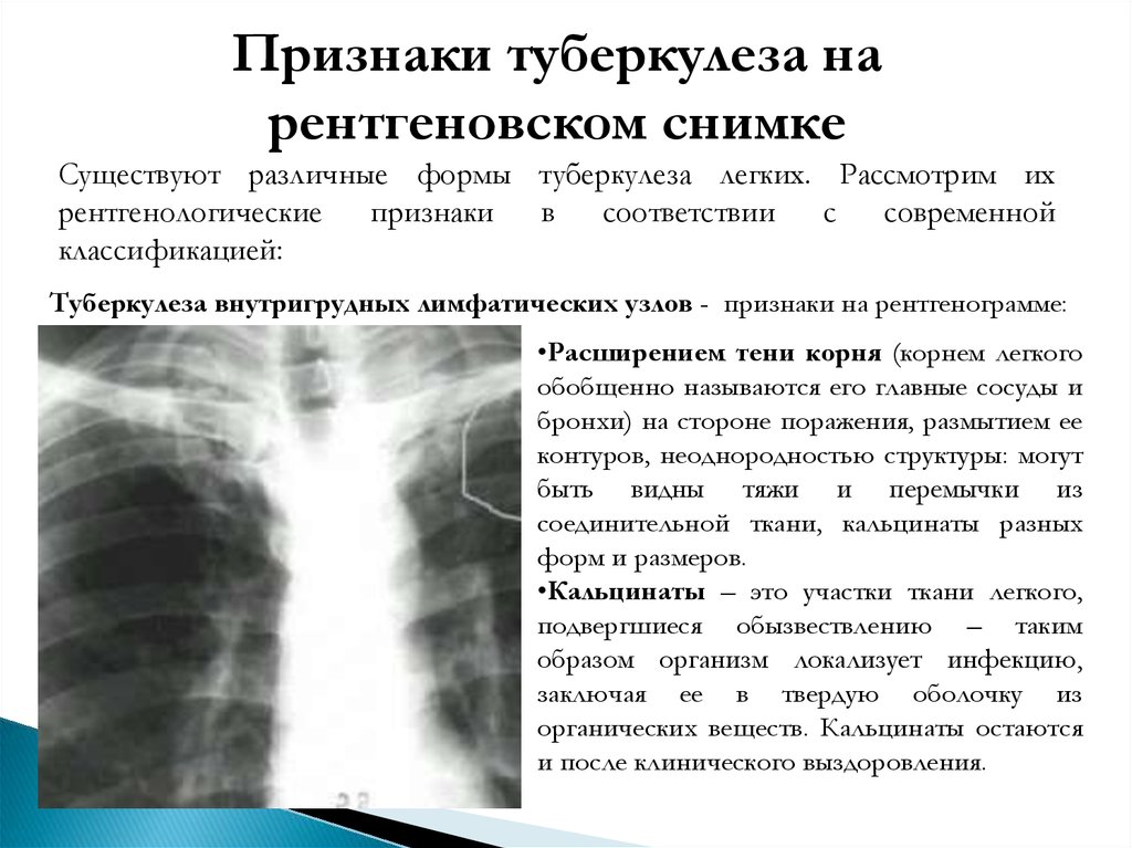 Кальцинаты в лимфоузлах. Диагностические критерии туберкулеза. Признаки туберкулёза лёгких на рентгене. Туберкулезный инфильтрат рентген. Рентген признаки туберкулеза легких.