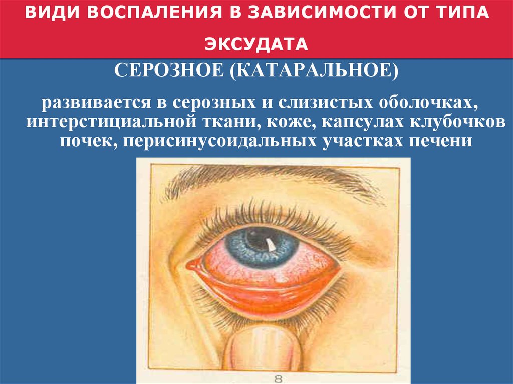 ВИДИ ВОСПАЛЕНИЯ В ЗАВИСИМОСТИ ОТ ТИПА ЭКСУДАТА