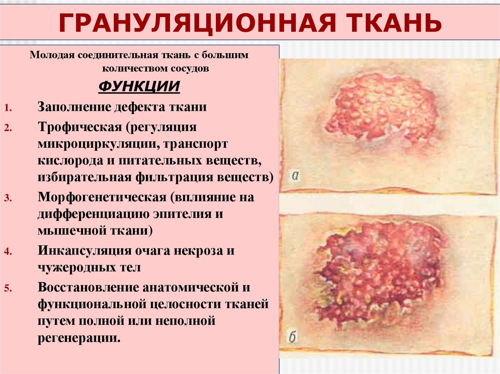 ГРАНУЛЯЦИОННАЯ ТКАНЬ