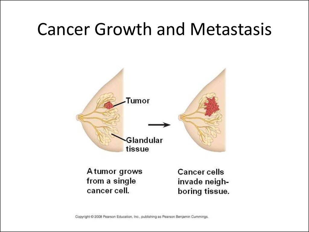 Cancer Growth and Metastasis