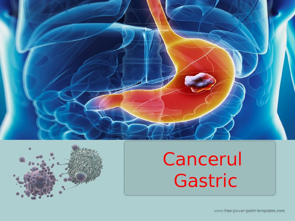 cancerul gastric tratament