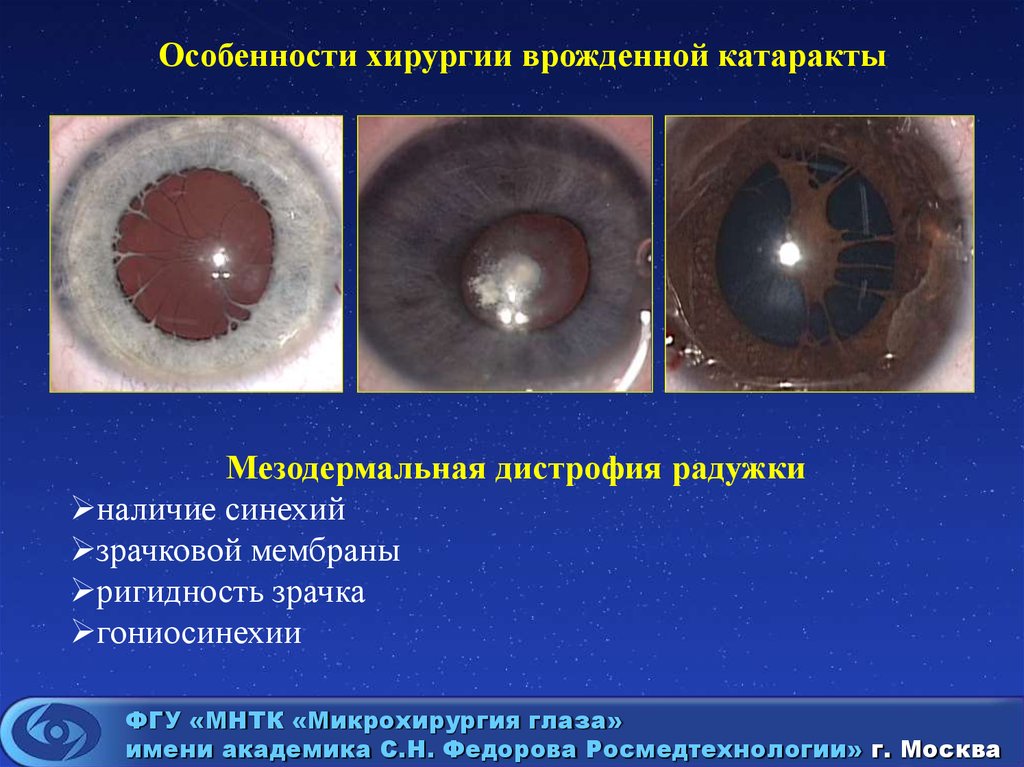 Врожденная катаракта. Эссенциальная мезодермальная прогрессирующая дистрофия Радужки. Прогрессирующая мезодермальная дистрофия Радужки Франк Каменецкого. Гониоскопия катаракта. Мезенхимальная дистрофия радужной оболочки.