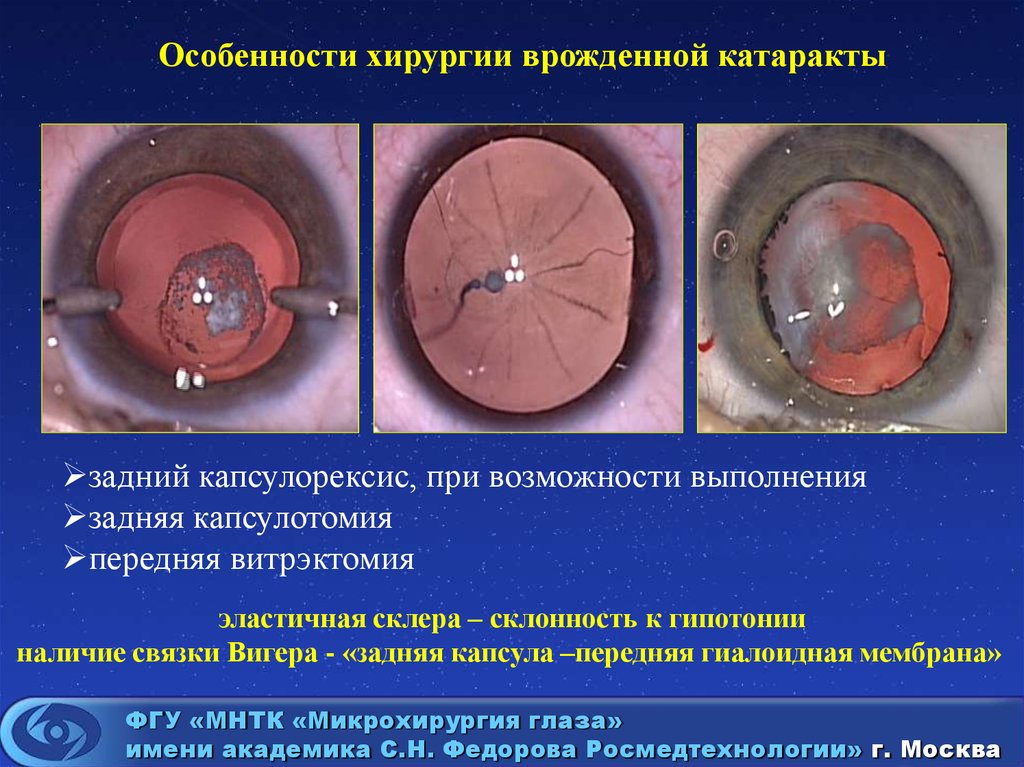 Новгород операция катаракта. Операции при врожденной катаракте. Передний капсулорексис.
